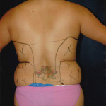 Liposuction 35