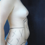 Liposuction 33