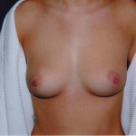 Breast Augmentation 51