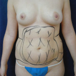 Liposuction 32