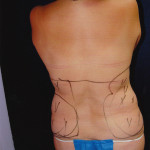 Liposuction 34