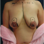 Breast Augmentation 33