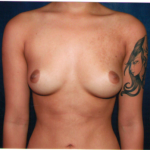 Breast Augmentation 40