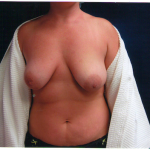 Breast Augmentation 35