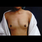 Breast Augmentation 28