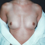 Breast Augmentation 27