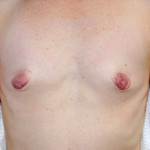 Breast Augmentation 21