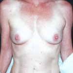 Breast Augmentation 20