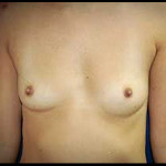 Breast Augmentation 9