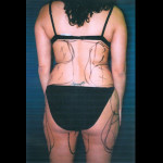 Liposuction 5