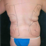 Liposuction 21